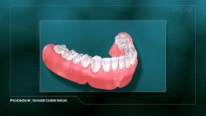 Removable Complete Dentures