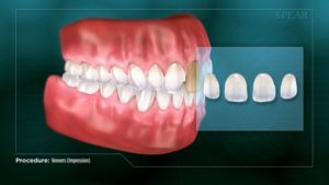 Veneers (Impression)