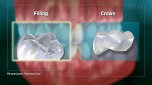 Filling Versus Crown (CAD/CAM)