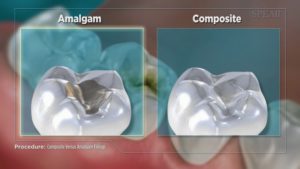 Composite Versus Amalgam Filling