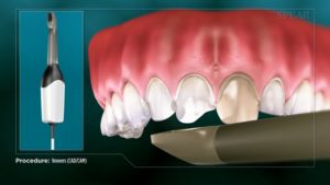 Veneers (CAD/CAM)