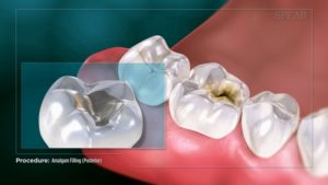 Amalgam Filling (Posterior)