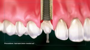 Single Implant (Anterior- Immediate Load)