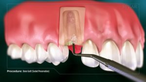 Bone Graft (Socket Preservation)