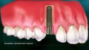 Single Implant (Anterior- Healing Cap)