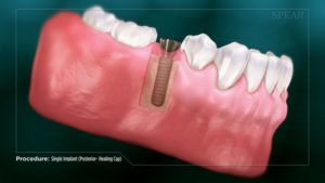 Single Implant (Posterior- Healing Cap)