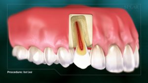 Apicoectomy