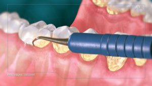 Debridement