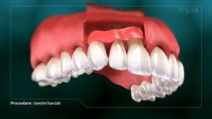 Connective Tissue Graft