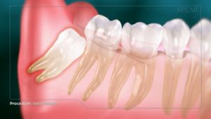 Impacted Third Molar