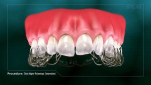 Clear Aligner Technology (Impression)