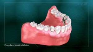 Removable Partial Dentures