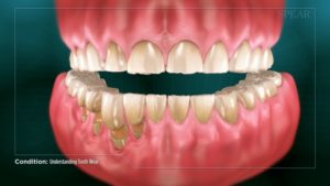 Understanding Tooth Wear