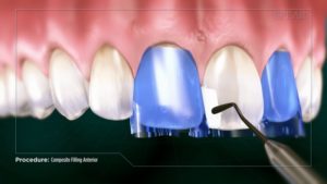 Composite Filling (Anterior)