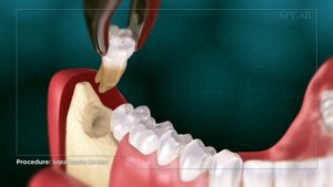 Surgical Extraction (3rd Molar)