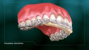 Anterior Bite Plane