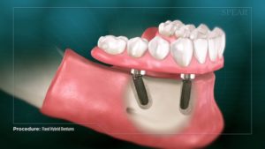 Fixed Hybrid Dentures