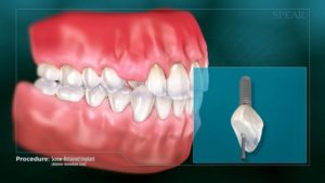 Screw-Retained Implant (Anterior- Immediate Load)