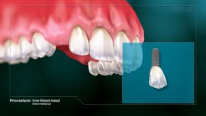 Clear Aligner Technology (CAD/CAM)