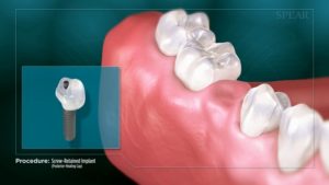 Screw-Retained Implant (Posterior- Healing Cap)