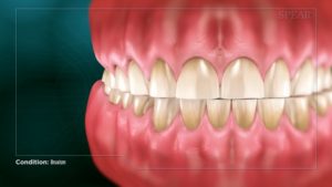 Bruxism (Clenching and Grinding)