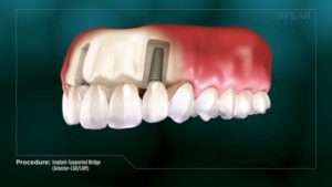 Implant-Supported Bridge (Anterior- CAD/CAM)