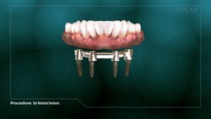 Bar Retained Overdenture