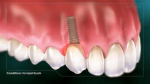 Peri-Implant Mucositis