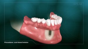 Locator Retained Overdenture (Reline)