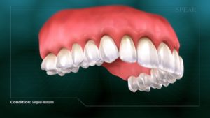 Gingival Recession