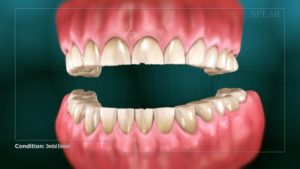 Dental Erosion