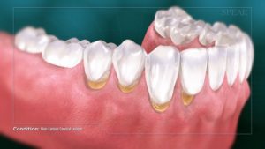 Non-Carious Cervical Lesions