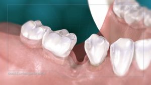 Consequences of Bone Loss