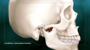 Temporomandibular Joint Disorder