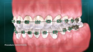 Traditional Orthodontics