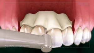 Crown Lengthening (Esthetic)