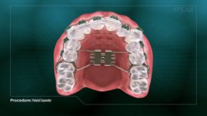 Palatal Expander