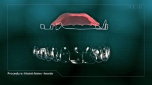 Orthodontic Retainers- Removable