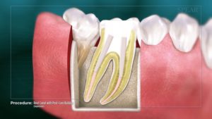 Root Canal with Post-Core Buildup- No File (Impression)