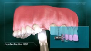 Bridge (Anterior- CAD/CAM)