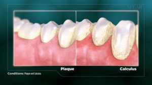 Plaque and Calculus