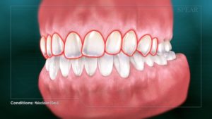 Malocclusion (Class I)