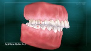 Malocclusion (Class II)