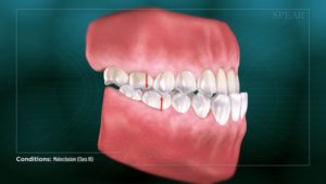 Malocclusion (Class III)