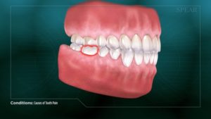 Causes of Tooth Pain