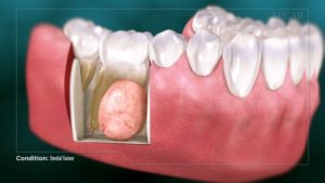 Dental Tumor