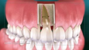 Trauma- Horizontal Root Fracture