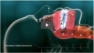 Mandibular Advancement Device