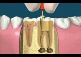 Endodontics Root Canal Therapy