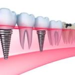 Bone Graft with Immediate Implant Placement